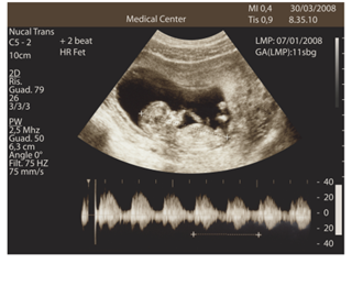 Antidepressants in the Womb May Increase Autism Risk Antidepressants in the Womb May Increase Autism Risk