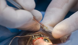 Cataract Surgery May Ease Mental Decline in Patients With Dementia Cataract Surgery May Ease Mental Decline in Patients With Dementia