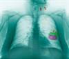 Vagus Nerve Stimulation in HIV-Associated Depression Vagus Nerve Stimulation in HIV-Associated Depression