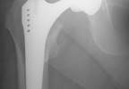 Hip Arthroplasty Risk in Men Higher With Increased Dairy Product Consumption Hip Arthroplasty Risk in Men Higher With Increased Dairy Product Consumption