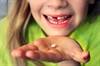 ASD Linked to Prenatal Metal Exposure According to Baby Teeth Findings ASD Linked to Prenatal Metal Exposure According to Baby Teeth Findings