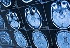 Hippocampal Volume Tied to Psychotic Disorders Hippocampal Volume Tied to Psychotic Disorders