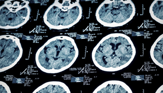 TBI Recovery Possible: Cognitive Impairment Can Improve With Targeted Brain Training TBI Recovery Possible: Cognitive Impairment Can Improve With Targeted Brain Training