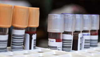 Proteins Identified for Alzheimer's Blood Test Proteins Identified for Alzheimer's Blood Test