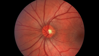Mental Health, Low Vision Program Cuts Depression in AMD Patients Mental Health, Low Vision Program Cuts Depression in AMD Patients