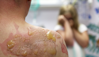 Serious Childhood Burns May Increase Depression, Suicide Risks Serious Childhood Burns May Increase Depression, Suicide Risks