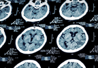 Psychosomatic Symptoms Linked to Longer Recovery Period for Concussions Psychosomatic Symptoms Linked to Longer Recovery Period for Concussions