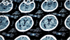 Protecting the Brain: The Damaging Impact of Traumatic Brain Injury Protecting the Brain: The Damaging Impact of Traumatic Brain Injury