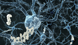 New Neurological Disorder Similar to Alzheimer's Identified New Neurological Disorder Similar to Alzheimer's Identified