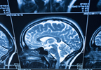 MRI Gadolinium Deposits in Brain Being Investigated MRI Gadolinium Deposits in Brain Being Investigated