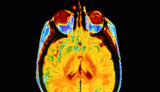 Ultrasound Treatment May Eliminate Alzheimer's Amyloid Plaque Ultrasound Treatment May Eliminate Alzheimer's Amyloid Plaque