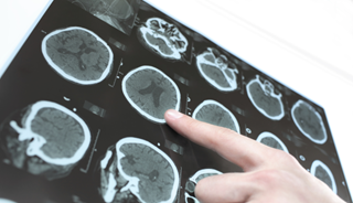 Vascular Conditions, Stroke May Have Implications for Alzheimer's Vascular Conditions, Stroke May Have Implications for Alzheimer's