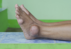 Gout May Lower Risk for Developing Alzheimer's Disease Gout May Lower Risk for Developing Alzheimer's Disease