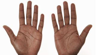 Finger Length May Predict Schizophrenia Finger Length May Predict Schizophrenia