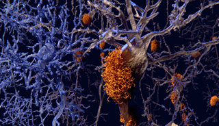 Questions Over Beta-Amyloid May Have Alzheimer's Treatment Ramifications Questions Over Beta-Amyloid May Have Alzheimer's Treatment Ramifications