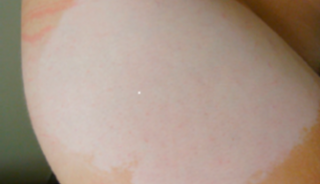The FDA has received 51 reports of chemical leukoderma associated with the use of the Daytrana patch. Photo courtesy of the American Academy of Dermatology. The FDA has received 51 reports of chemical leukoderma associated with the use of the Daytrana patch. Photo courtesy of the American Academy of Dermatology.