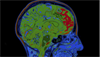 Cognitive Dysfunction Evaluated by fMRI in Non-Neuropsychiatric SLE Cognitive Dysfunction Evaluated by fMRI in Non-Neuropsychiatric SLE