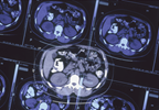 Brain Size May Predict Alzheimer's Risk Brain Size May Predict Alzheimer's Risk