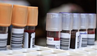 Early Alzheimer's Detection Possible With New Blood Test Early Alzheimer's Detection Possible With New Blood Test