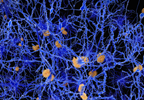 Novel Case: Alzheimer's Reported in HIV+ Patient Novel Case: Alzheimer's Reported in HIV+ Patient