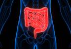 Colonic Diverticular Disease May Increase Dementia Risk Colonic Diverticular Disease May Increase Dementia Risk