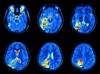 The Effect of Cognitive Remediation Training on Functional Connectivity and Social Cognition in Schizophrenia The Effect of Cognitive Remediation Training on Functional Connectivity and Social Cognition in Schizophrenia