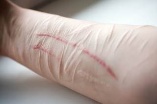 Cutting is the most common form of nonsuicidal self-injury, accounting for approximately 70% of patients who self-injure. Cutting is the most common form of nonsuicidal self-injury, accounting for approximately 70% of patients who self-injure.