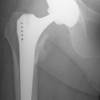 Hip Arthroplasty Risk in Men Higher With Increased Dairy Product Consumption Hip Arthroplasty Risk in Men Higher With Increased Dairy Product Consumption