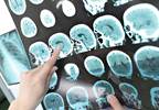 Neuroinflammation Associated With Anxiety, Depression in Multiple Sclerosis Neuroinflammation Associated With Anxiety, Depression in Multiple Sclerosis