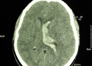 Preadmission treatment with SSRIs does not increase the risk for postthrombolysis symptomatic intracerebral hemorrhage in patients with ischemic stroke. Preadmission treatment with SSRIs does not increase the risk for postthrombolysis symptomatic intracerebral hemorrhage in patients with ischemic stroke.