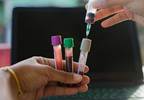 Neuropsychiatric Events May Be Linked to Nitrated Nucleosome Levels in Lupus Neuropsychiatric Events May Be Linked to Nitrated Nucleosome Levels in Lupus