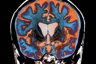 Researchers collected data from the baseline visits of 487 individuals with the Huntington disease mutation. Researchers collected data from the baseline visits of 487 individuals with the Huntington disease mutation.