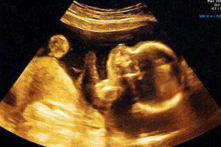 In logistical regression models, no association was found between in utero SSRI exposure and special education needs. In logistical regression models, no association was found between in utero SSRI exposure and special education needs.