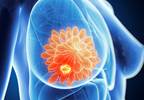 How Depression Treatment Affects Cancer Survival: SMaRT Oncology-2 and 3 How Depression Treatment Affects Cancer Survival: SMaRT Oncology-2 and 3