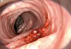 Increased Prevalence of Depression, Anxiety After Colorectal Cancer Increased Prevalence of Depression, Anxiety After Colorectal Cancer