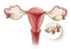 Adverse Neurodevelopmental and Mental Health Outcomes in PCOS Adverse Neurodevelopmental and Mental Health Outcomes in PCOS