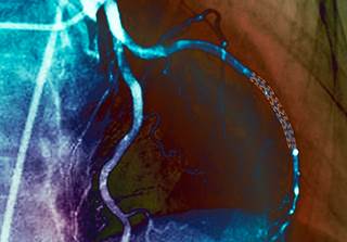 Depression may be a risk factor for cardiovascular disease onset in individuals with no history. Depression may be a risk factor for cardiovascular disease onset in individuals with no history.