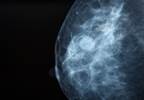 Risk of Breast Cancer May Be Higher in Women With Schizophrenia Risk of Breast Cancer May Be Higher in Women With Schizophrenia