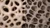 Bone Mineral Density Improved With Intravenous Ibandronate in Osteoporosis Bone Mineral Density Improved With Intravenous Ibandronate in Osteoporosis