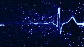 Dysregulation of the autonomic nervous system is more likely to be a risk factor for depression rather than a sequela. Dysregulation of the autonomic nervous system is more likely to be a risk factor for depression rather than a sequela.