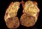 Child Neuroblastoma Survivors at Risk for Psych Impairment Child Neuroblastoma Survivors at Risk for Psych Impairment