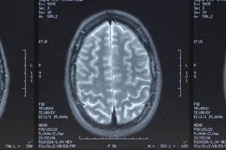 Gray matter volumes within the limbic-striatal, cerebellum, and occipital networks may be critical neural markers. Gray matter volumes within the limbic-striatal, cerebellum, and occipital networks may be critical neural markers.