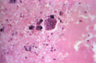 Latent toxoplasma infection is 3 times more frequent in patients with schizophrenia than in the general population. Latent toxoplasma infection is 3 times more frequent in patients with schizophrenia than in the general population.
