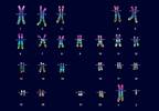 Low Testosterone Linked With Social Anxiety in Boys With Klinefelter Syndrome Low Testosterone Linked With Social Anxiety in Boys With Klinefelter Syndrome