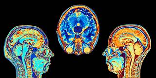 Left superior frontal cortex, left rostral medial frontal cortex, right white matter total volume, and right lateral ventricle volume could predict FAST scores. Left superior frontal cortex, left rostral medial frontal cortex, right white matter total volume, and right lateral ventricle volume could predict FAST scores.