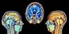 Brain Volume Changes Predict Functioning in Bipolar Disorder Brain Volume Changes Predict Functioning in Bipolar Disorder