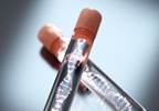 Immune Variations Appear to Be Unrelated to Psychosis, Schizophrenia Immune Variations Appear to Be Unrelated to Psychosis, Schizophrenia
